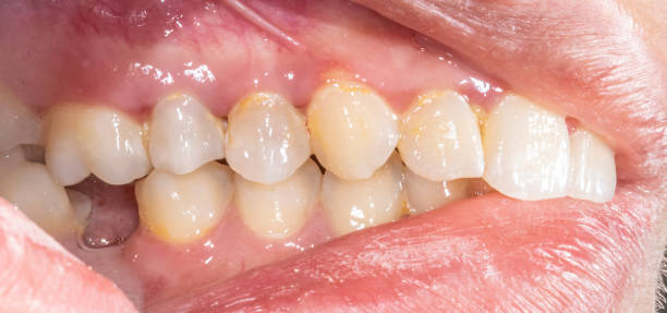 istock Lateral view of dental arches in biting occlusion with a lost lower molar tooth missing crown. 2154757697