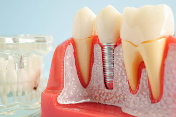 istock Artificial tooth roots dental implant into jaw, Root canal model for dentist. 2154842448
