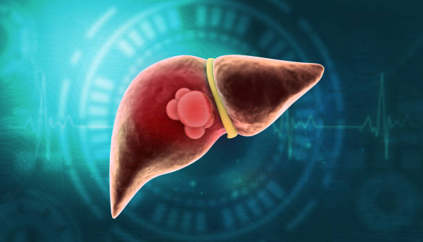 istock Liver cancer concept 2154850871