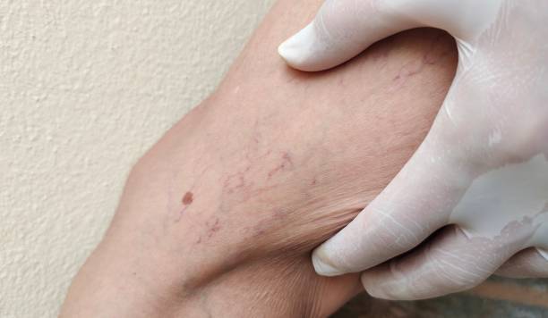 istock The varicose veins and spider on the leg. 2154986377