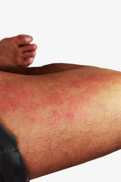 istock Leg area of man with dermatitis problem of rash 2155106162