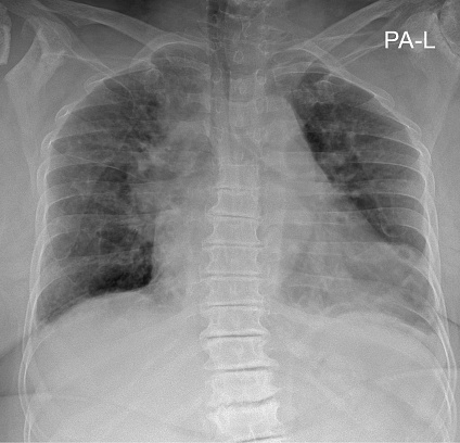 Patient Chest Elderly Patient Chest Xray Stock Photo - Download Image Now - Aging ...