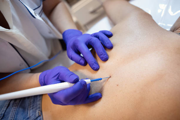 istock Dermatologist using a laser electrocoagulator on her patient's moles 2155224824