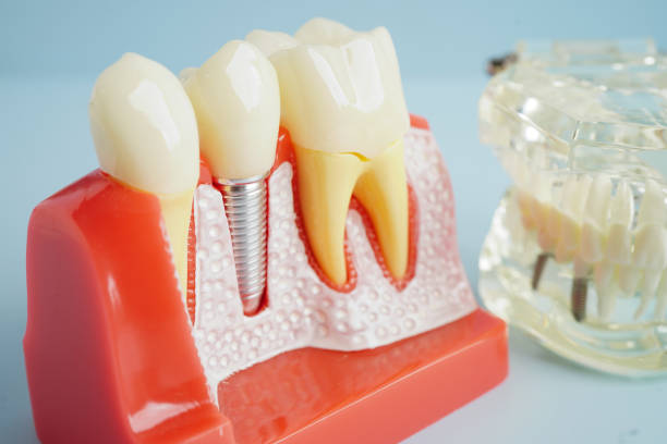 istock Artificial tooth roots dental implant into jaw, Root canal model for dentist. 2155276725