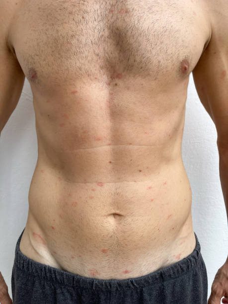 Pityriasis rosea rash on man torso