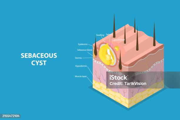 Cysts Graphics 3d Isometric Flat Vector Conceptual Illustration Of Sebaceous Cyst ...