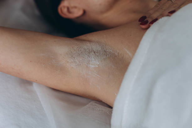 istock Sugaring: epilation with liquate sugar at armpit. 2155514649