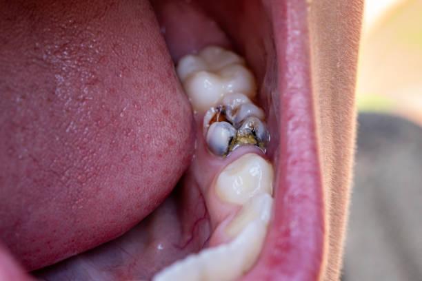 Decayed tooth root canal treatment. Tooth or teeth decay of lower molar. Restoration with a composite filling. caries. bad rotten teeth. Dental temporary restorative material. Dental concept. close up