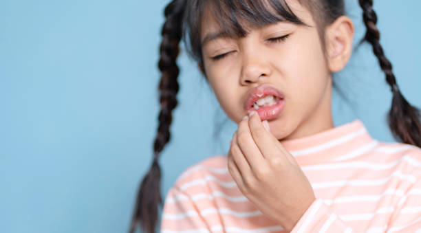 istock Little girl dry and peeling lips.Dry lips, peeling lips. 2155611630