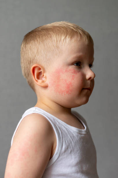 istock Child with rash on face and arms in white shirt 2155772450
