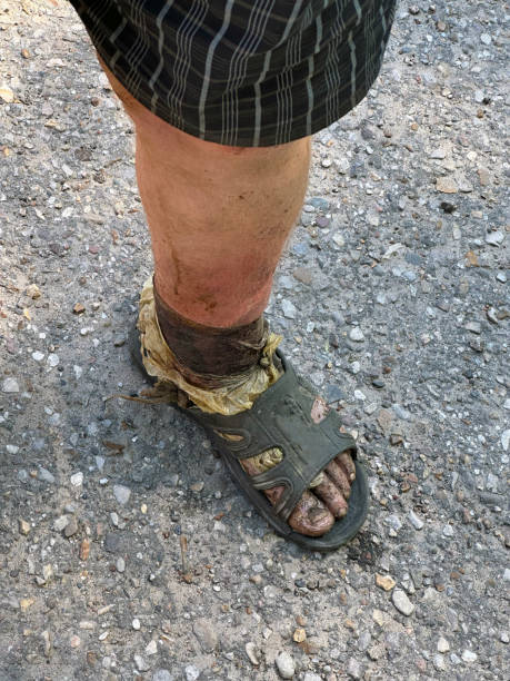 gangréna na mužské noze - gangréna - stock snímky, obrázky a fotky