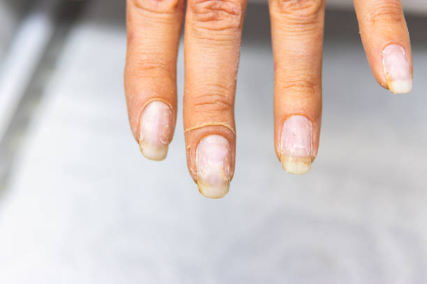 istock Close-up of nails before manicure treatment 2155938842
