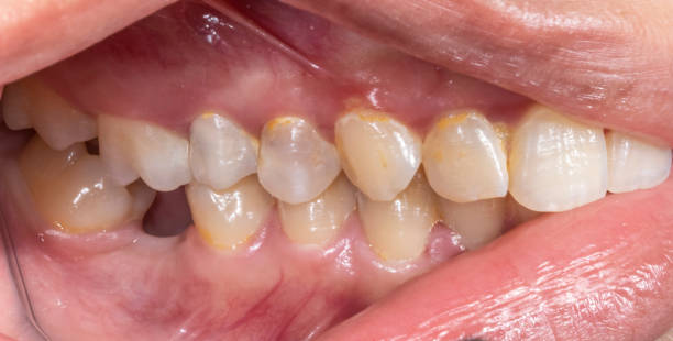 istock Lateral view of dental arches in biting occlusion with a lost lower molar tooth missing crown. 2155987673