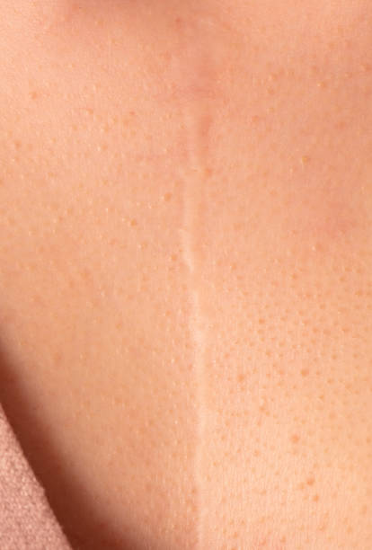 istock Scar on human skin after heart surgery 2155996435