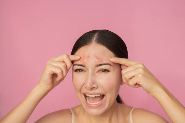 istock woman looking at camera, showing pimples on her forehead with her fingers and crying. 2156192517