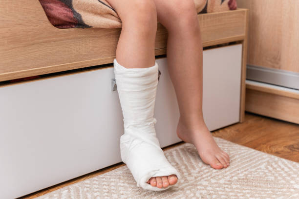 kinderbeine, ein bein ist gebrochen und eingegipst - gipsverband stock-fotos und bilder