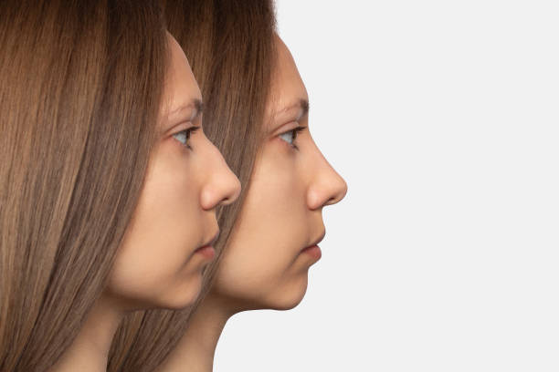 istock Collage before and after plastic surgery on the nose, rhinoplasty 2156296996