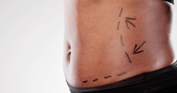 Precision in Practice: A Surgeon's Expertise in Drawing Correction Lines for Abdominoplasty Procedure Precision in Practice: A Surgeon's Expertise in Drawing Correction Lines for Abdominoplasty Procedure on an African American Woman Body Contouring stock pictures, royalty-free photos & images