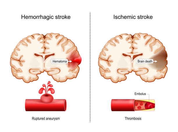 Hemorrhagic and Ischemic strokes. Hemorrhagic and Ischemic strokes. Cerebral infarction. Cross sections of human brain with Hematoma and part of Brain death. Close-up of blood vessel with Ruptured aneurysm and cut of artery with Embolus. Thrombosis. Vector poster hematoma images stock illustrations