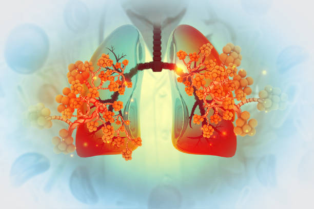 istock Alveoli in lungs. Lung disease concept. 3d illustration 2156342400