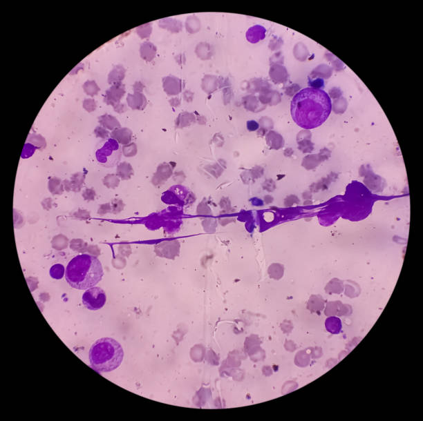 istock Bone marrow study (BMD). Amegakariocytic thrombocytopenia with dimorphic erythroid hyperplasia. Progressive marrow failure syndrome. It's a group of cancer. 2156364018