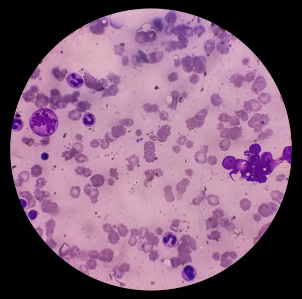 istock Bone marrow study (BMD). Amegakariocytic thrombocytopenia with dimorphic erythroid hyperplasia. Progressive marrow failure syndrome. It's a group of cancer. 2156364079