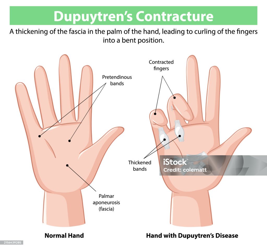 Normal Hand Development Comparison Of Normal Hand And Affected Hand Stock Illustration ...