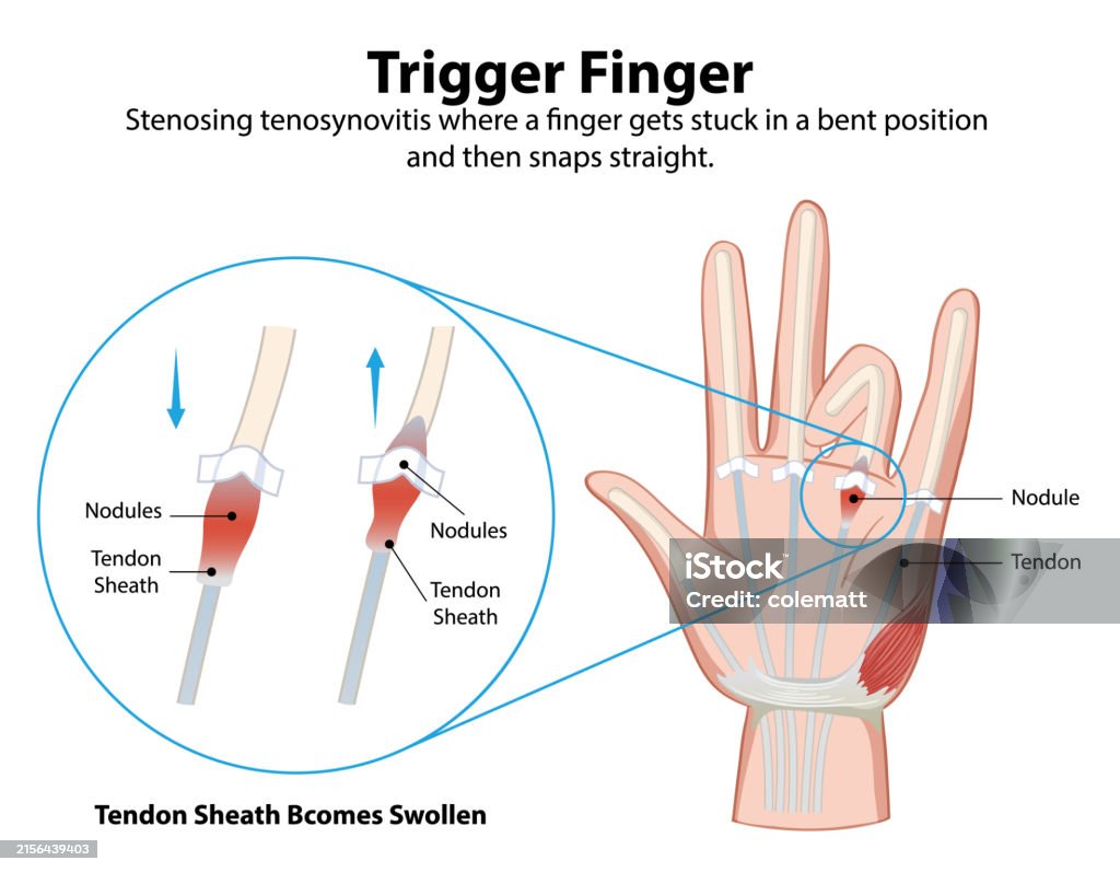 Diagram Explaining Trigger Finger Condition Stock Illustration ...