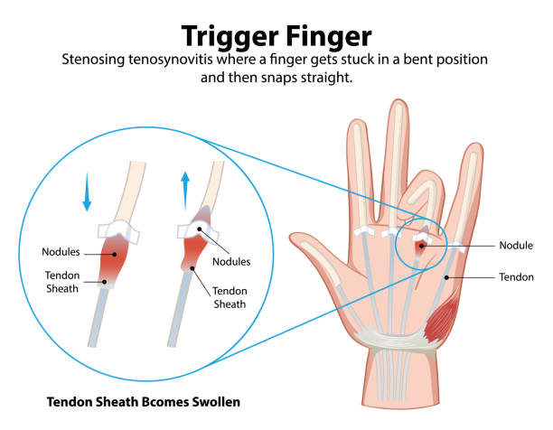 Diagram explaining trigger finger condition Diagram explaining trigger finger condition index finger stock illustrations