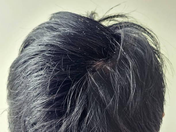 istock Dandruff on black hair of men 2156449115