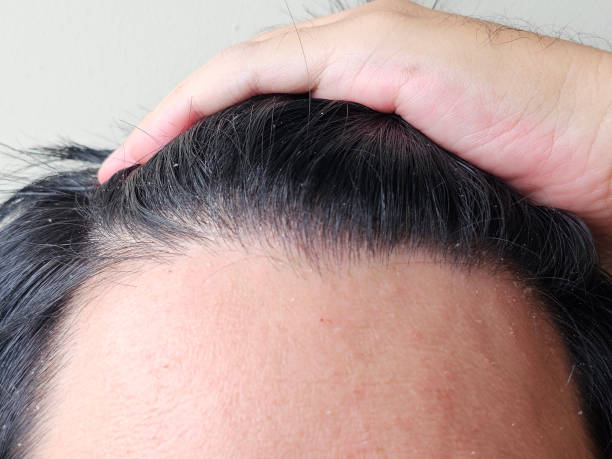 istock Men with black hair can experience dandruff on their forehead. 2156449118