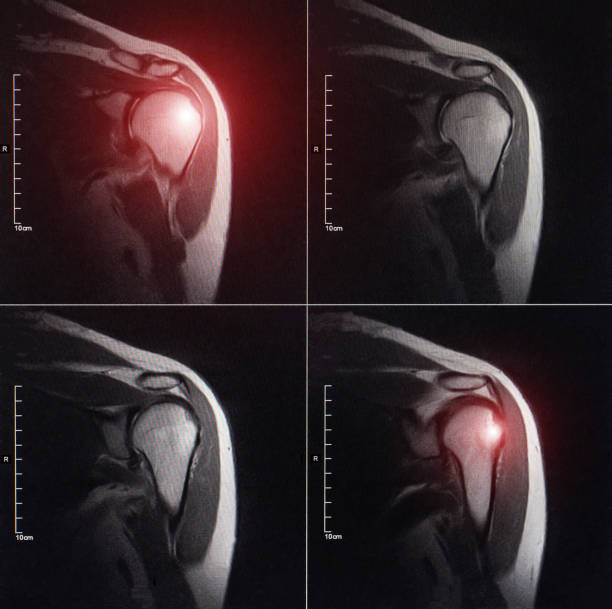 MRI image of the shoulder joint after a fracture and dislocation. Impression fracture of the humeral head. Shoulder injury, sprain, synovitis. The redness and inflammation are red on the MRI image, close-up imagen por resonancia magnética de la articulación del hombro después de una fractura y dislocación. fractura por impresión de la cabeza humeral. lesión en el hombro, esguince, sinovitis. el enrojecimiento y la inflamación son rojos en la imagen de