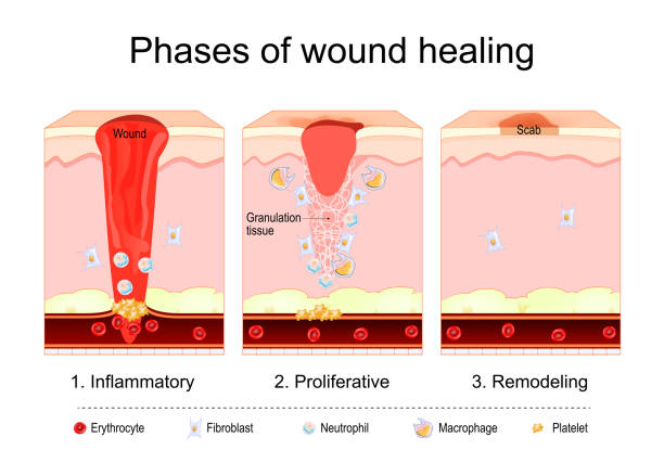 Wound healing process. Tissue repair Wound healing process. Tissue repair. Inflammatory, Proliferative, Remodeling phase. Cross section of human skin after trauma. Disruption and damage of tissue and blood vessel. Bleeding. Vector illustration hematoma images stock illustrations