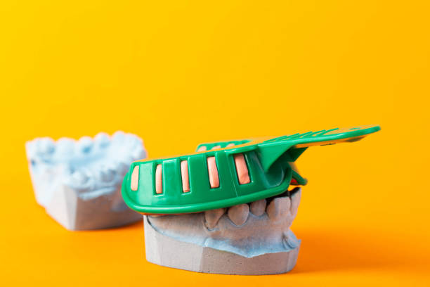Green dental impression tray on a blue plaster jaw of a patient on a orange background. The concept of taking an impression of the jaw for the manufacture of crowns and dental prostheses. Orthodontics, copy space for text, dentistry cubeta de impresión dental verde sobre una mandíbula de yeso azul de un paciente sobre un fondo naranja. el concepto de toma de impresión de la mandíbula para la fabricación de coronas y prótesis dentales. ortodoncia, espacio de copia para texto