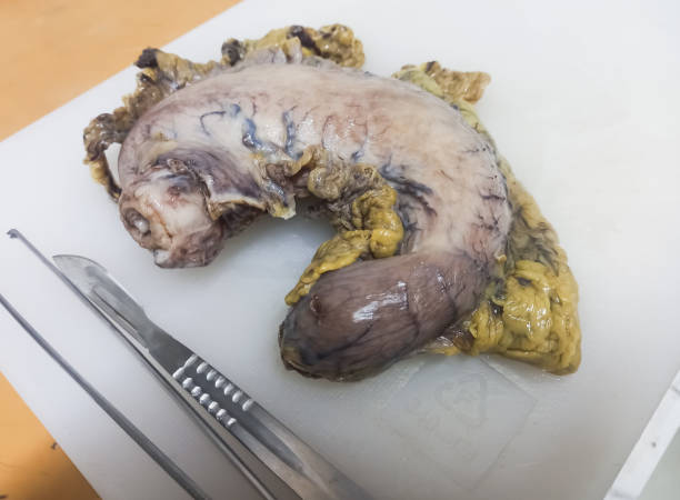 Resected whole stomach after operation at laboratory for biopsy. Gastric biopsies.