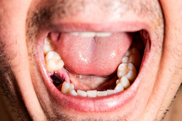 istock Caucasian man's mouth with a recent dental extraction 2156555401
