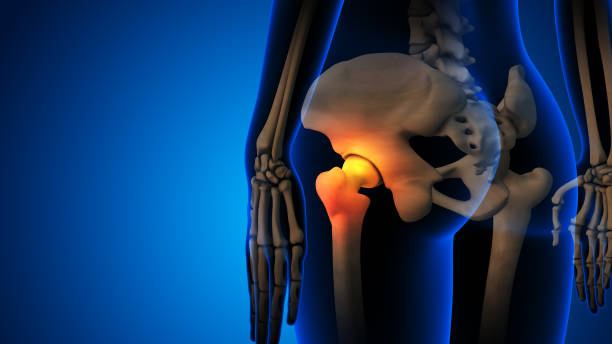 Skeleton with osteoarthritis hip joint pain This stock image illustrates the skeletal structure affected by osteoarthritis, focusing on hip joint pain. It provides a detailed view of the bones involved, including the femur and pelvis, highlighting areas of inflammation and degeneration typical in this condition. The visual aids demonstrate the pathology of osteoarthritis, which leads to joint pain. This educational content is valuable for understanding the anatomical and physiological changes occurring in the hip joint. hip replacement stock pictures, royalty-free photos & images