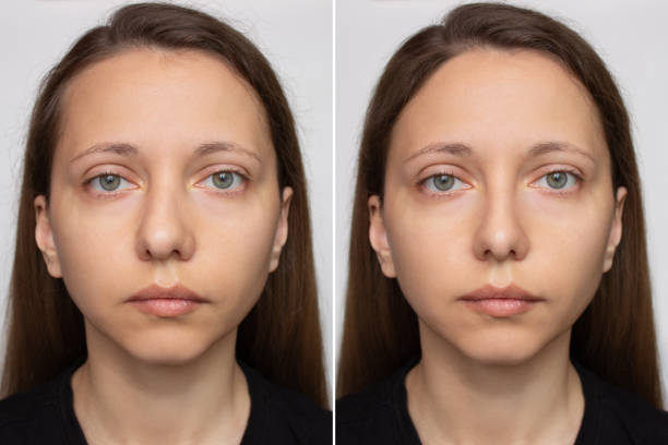 istock Collage before and after plastic surgery on the nose 2156616832