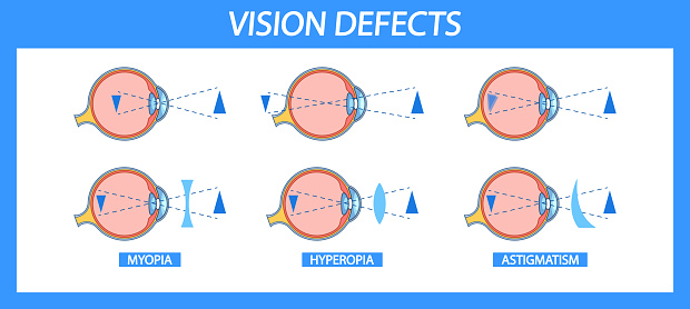 Defects In Vision Informative Chart Detailing Myopia Hyperopia And Astigmatism In Eye ...