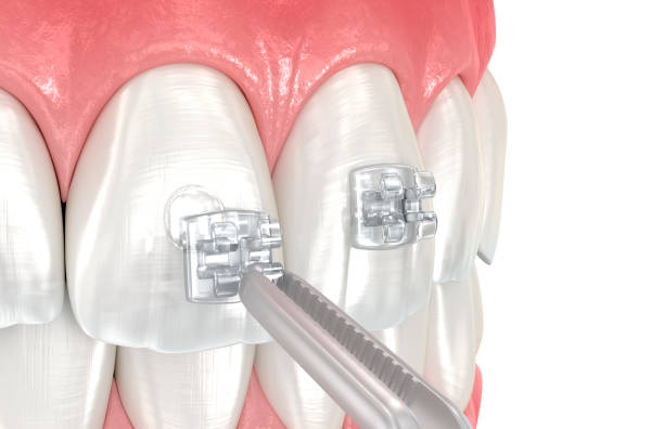 Creal braces placement over tooth. Dental 3D illustration