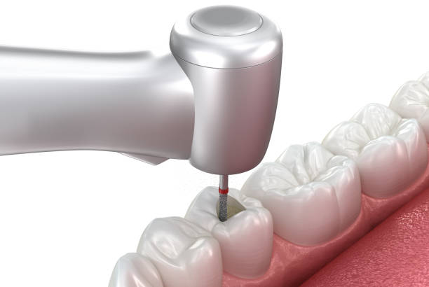 istock Making access to the root canal. Medically accurate tooth 3D illustration. 2156936250