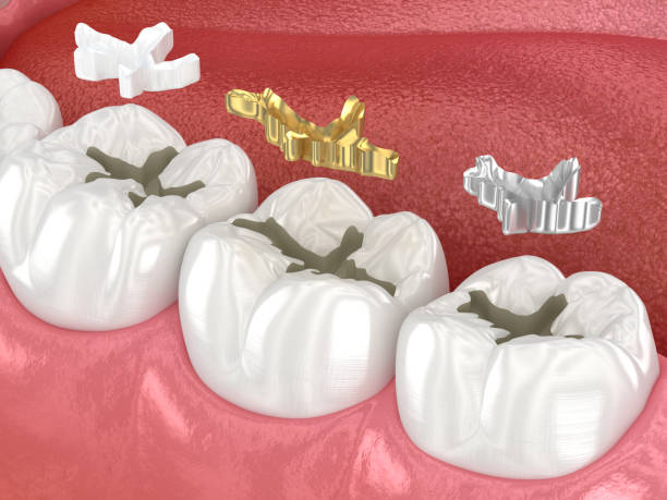 istock Dental fillings: ceramic, golden, metal. Dental 3D illustration 2156936271