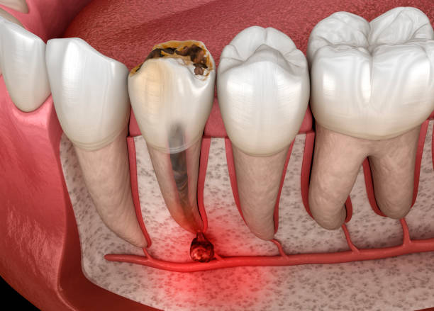 istock Periostitis tooth - Lump on Gum Above Tooth. Dental 3D illustration 2156936281