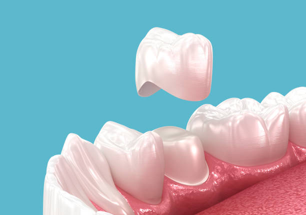 dental crown placement over tooth. 3d illustration - corona-dental fotografías e imágenes de stock