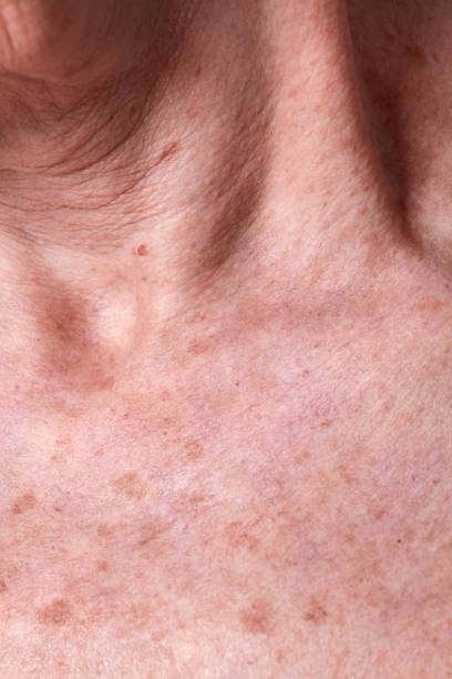 istock Aging female skin with melasma spots 2157213906