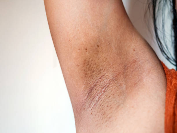 istock Close-up of Women armpit with problem black armpit. Dark and wrinkle armpit from deodorant allergic. 2157261501