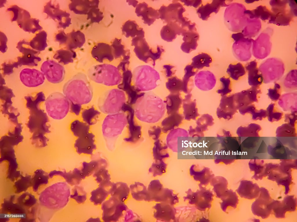 Aml Microscope Slide Acute Myeloblastic Leukemia Close Up Micrograph Stock Photo - Download ...