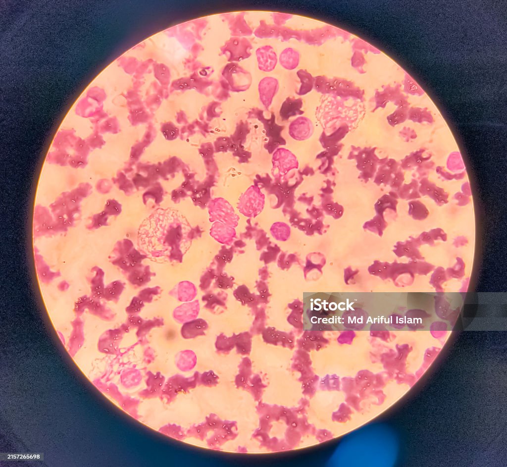 Aml Microscope Slide Acute Myeloblastic Leukemia Analysed By Light Microscope Stock Photo ...