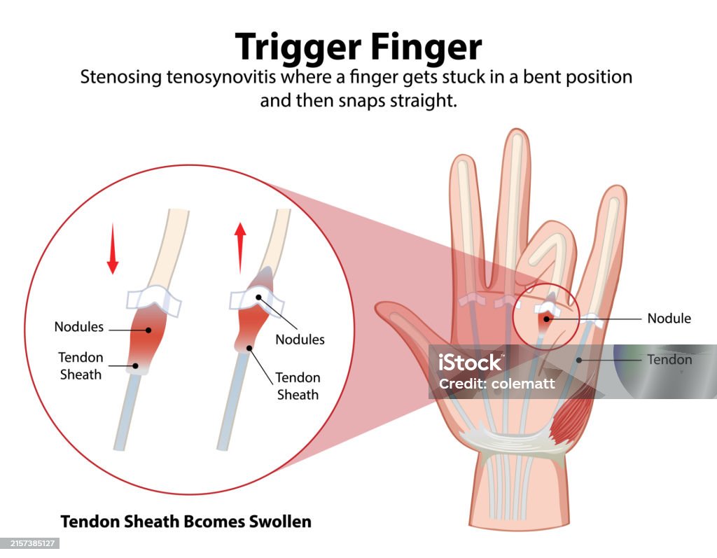 Trigger Finger Visual Diagram Explaining Trigger Finger Condition And Symptoms Stock ...