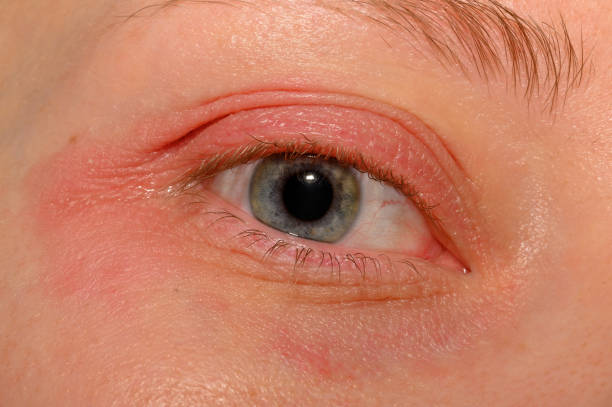 istock Swollen eyelids, eye infection, demodex 2157398540